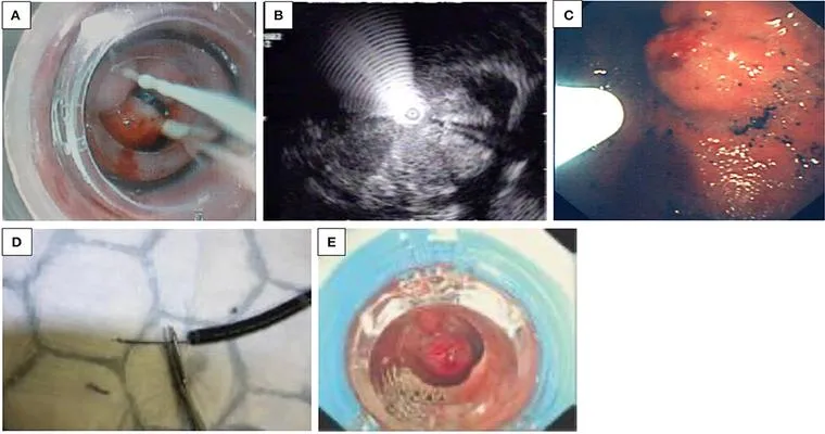 Anyone have experience with an upper GI endoscopy for a 95-year-old with dementia?