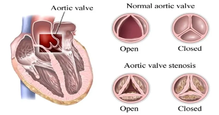 Dad update: aortic stenosis, valve replacement at 93?