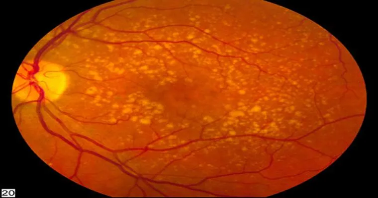 An Overview of Age-Related Macular Degeneration