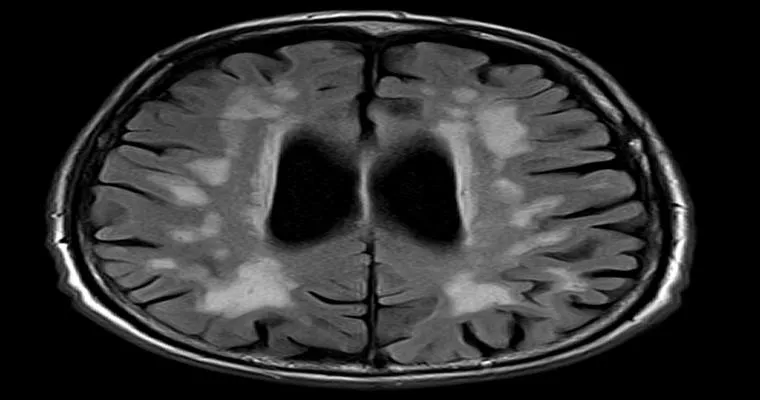 What is Multi-Infarct Dementia?