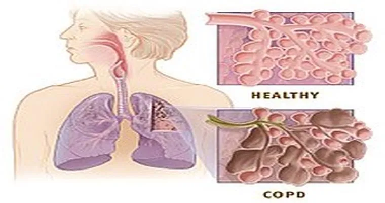 An Overview of COPD
