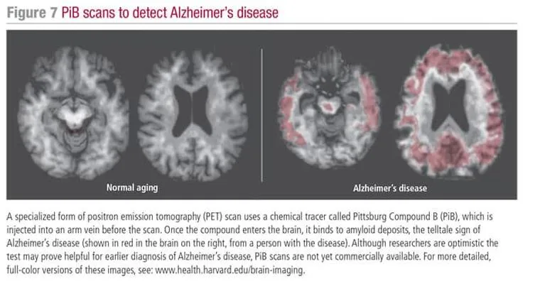 Alzheimer’s Diagnosis: What Next?