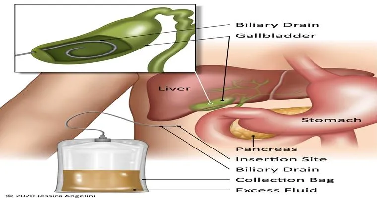 Anyone have a parent live with a gallbladder drain for an extended period of time? Any tips or suggestions?