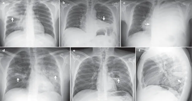 Pneumonia and a decline. Is there a connection?
